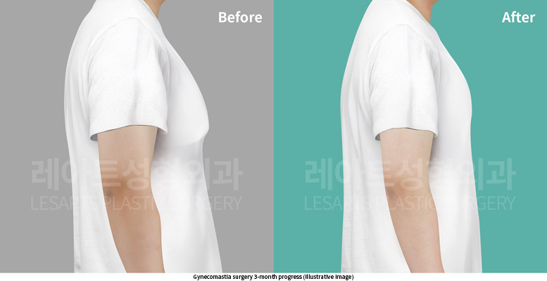 gynecomastia_02_06_250625