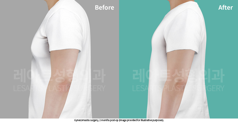 gynecomastia_02_06_250702