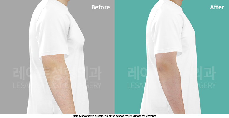 gynecomastia_02_08_250618