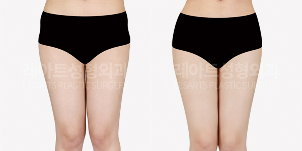hip_dip_fat_transfer_01_thumbnail_250619