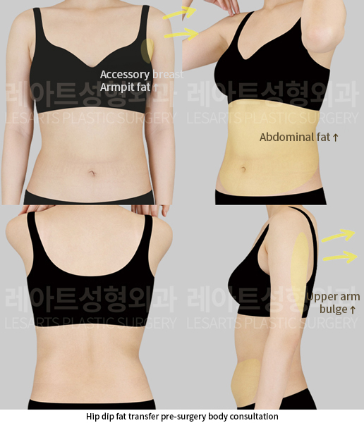 hip_dip_fat_transfer_02_01_250619