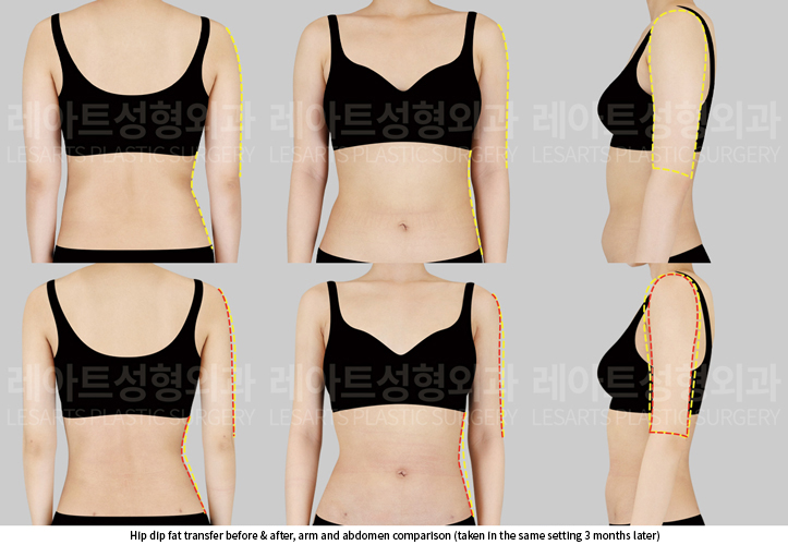 hip_dip_fat_transfer_02_03_250619