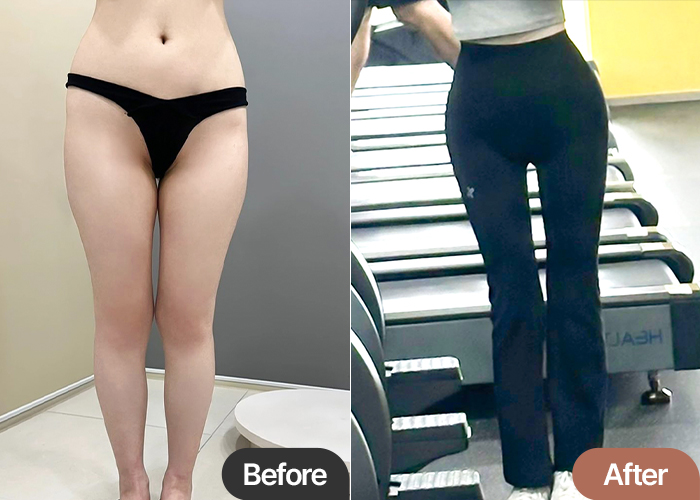Thigh Liposuction and Hip Fat Transfer in Korea – Smooth Hip Line & Slim Legs at Lesarts Plastic Surgery