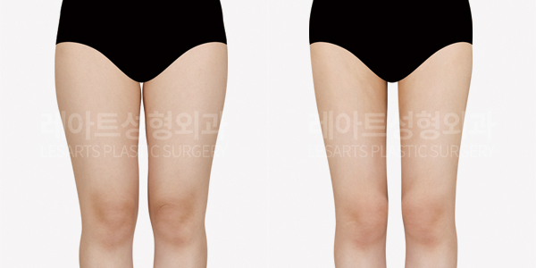 thigh_liposuction_01_thumbnail_250508