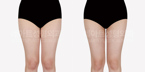 thigh_liposuction_01_thumbnail_250515