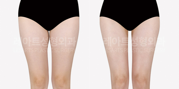 thigh_liposuction_01_thumbnail_250522