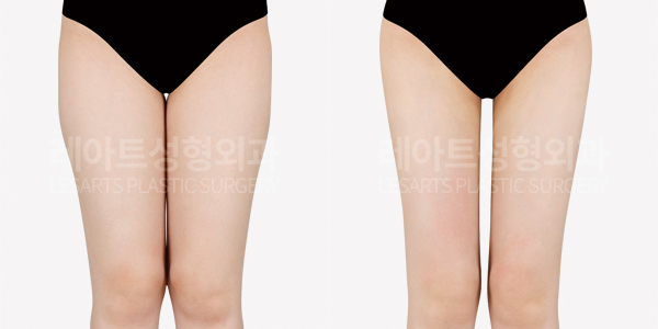 thigh_liposuction_01_thumbnail_250604