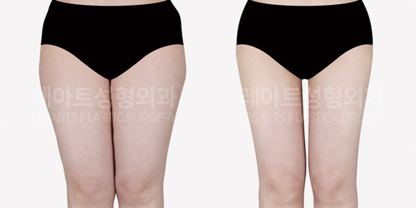 thigh_liposuction_01_thumbnail_250605