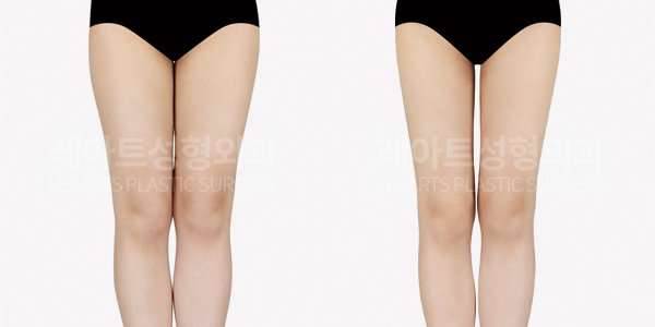 thigh_liposuction_01_thumbnail_250626