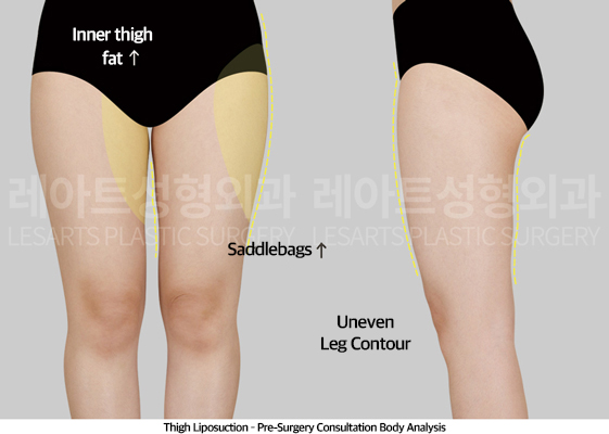 thigh_liposuction_02_01_250508