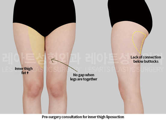 thigh_liposuction_02_01_250515