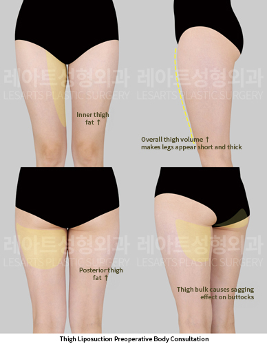 thigh_liposuction_02_01_250522