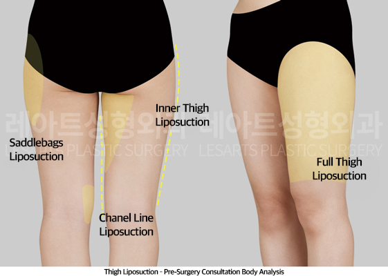 thigh_liposuction_02_02_250508