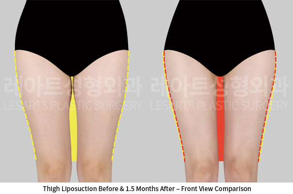 thigh_liposuction_02_02_250522