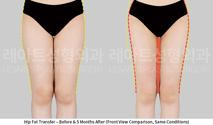 thigh_liposuction_02_02_250604