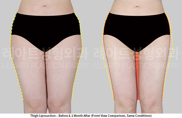 thigh_liposuction_02_02_250605