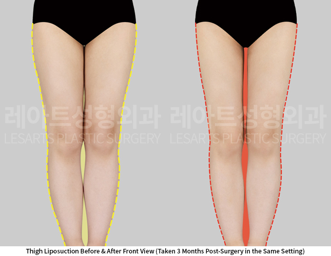 thigh_liposuction_02_02_250626