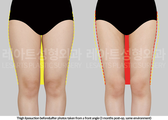 thigh_liposuction_02_03_250508