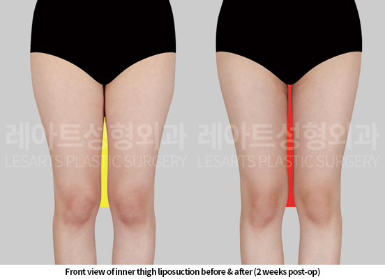 thigh_liposuction_02_03_250515