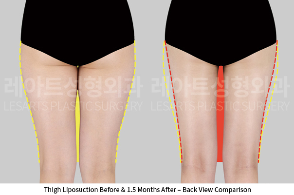 thigh_liposuction_02_03_250522