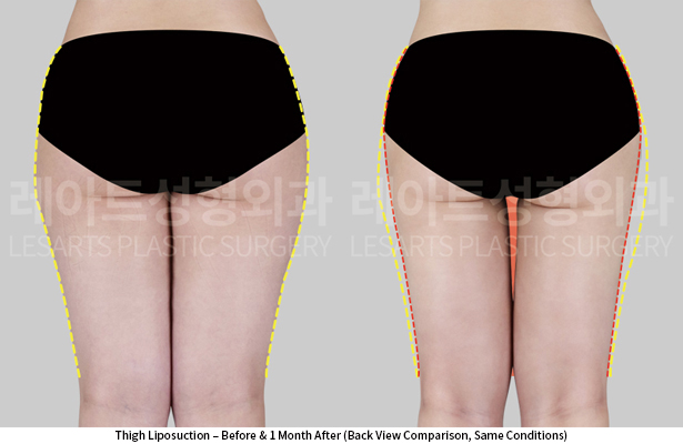 thigh_liposuction_02_03_250605