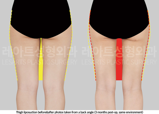 thigh_liposuction_02_04_250508