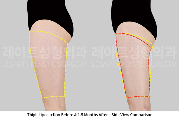 thigh_liposuction_02_04_250522
