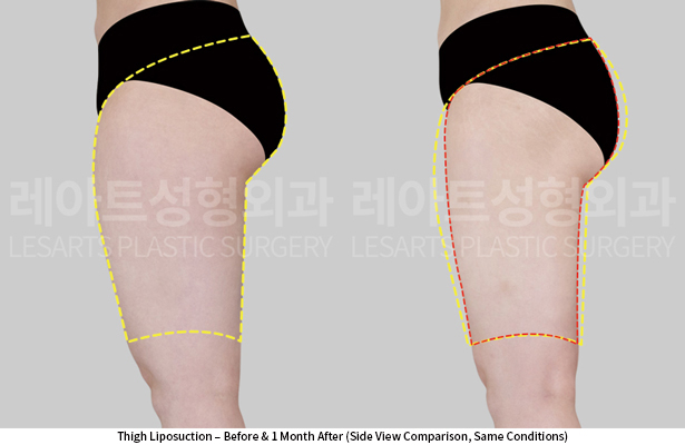 thigh_liposuction_02_04_250605