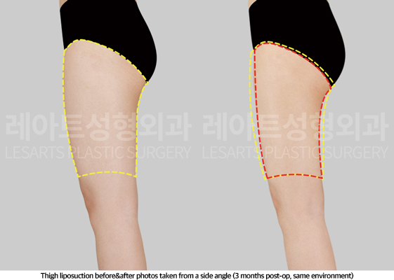 thigh_liposuction_02_05_250508
