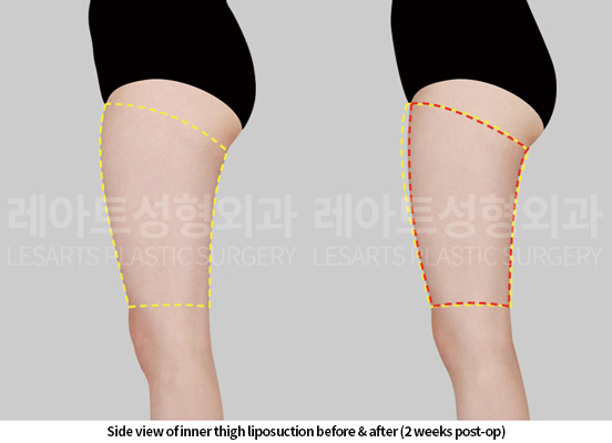 thigh_liposuction_02_05_250515