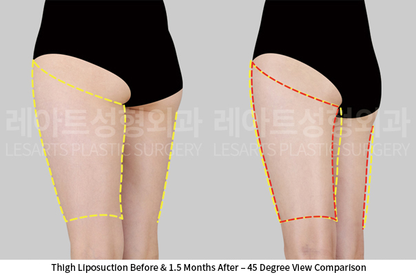 thigh_liposuction_02_05_250522