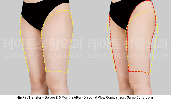 thigh_liposuction_02_05_250604