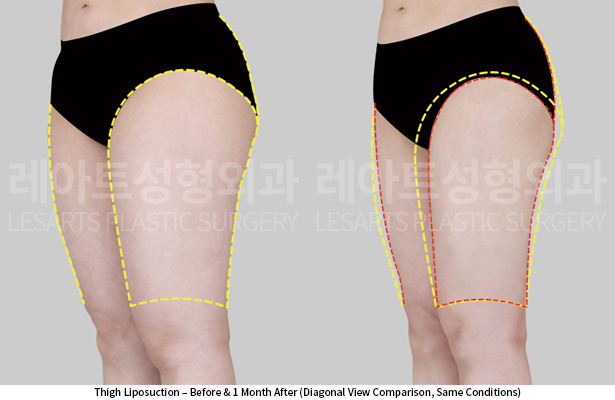 thigh_liposuction_02_05_250605