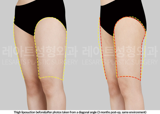thigh_liposuction_02_06_250508