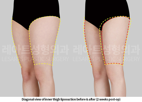 thigh_liposuction_02_06_250515