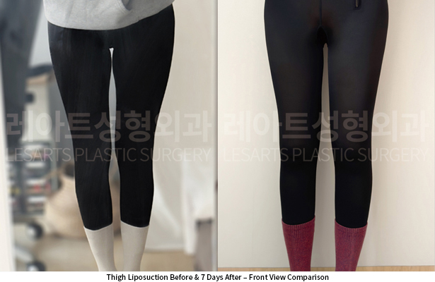 thigh_liposuction_02_06_250522