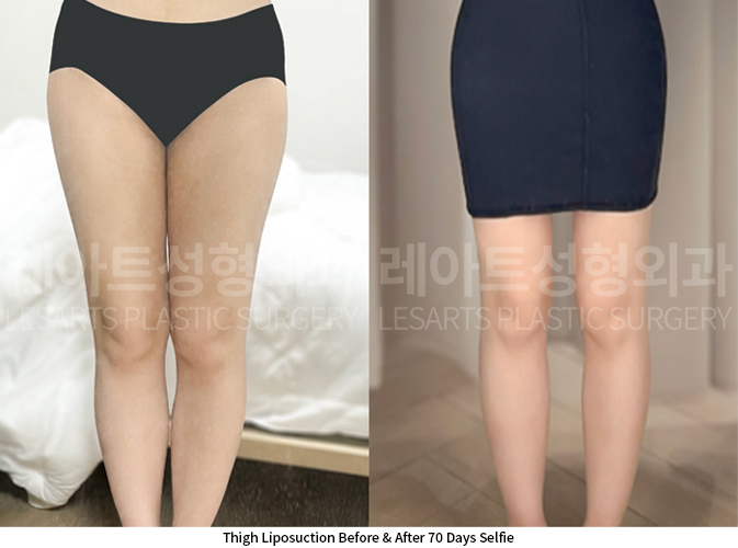 thigh_liposuction_02_06_250626