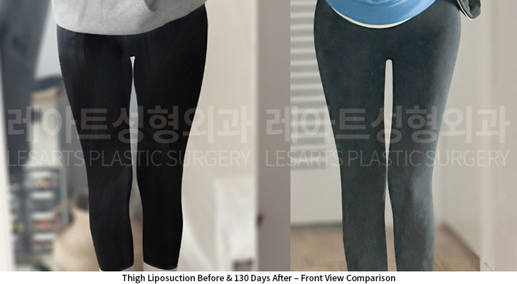 thigh_liposuction_02_07_250522