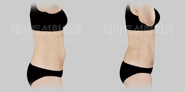tummy_tuck_01_thumbnail_250429