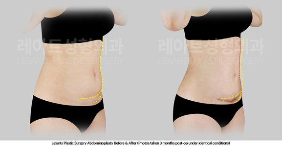 tummy_tuck_02_03_250429