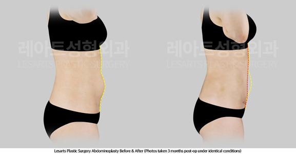 tummy_tuck_02_04_250429