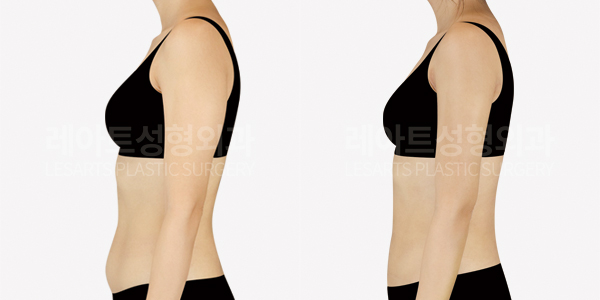 upper_body_liposuction_01_thumbnail_250528