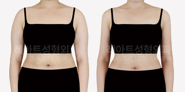 upper_body_liposuction_01_thumbnail_250613