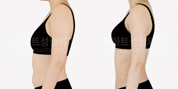 upper_body_liposuction_01_thumbnail_250624