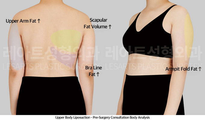 upper_body_liposuction_02_01_250513