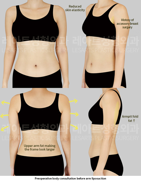 upper_body_liposuction_02_01_250528