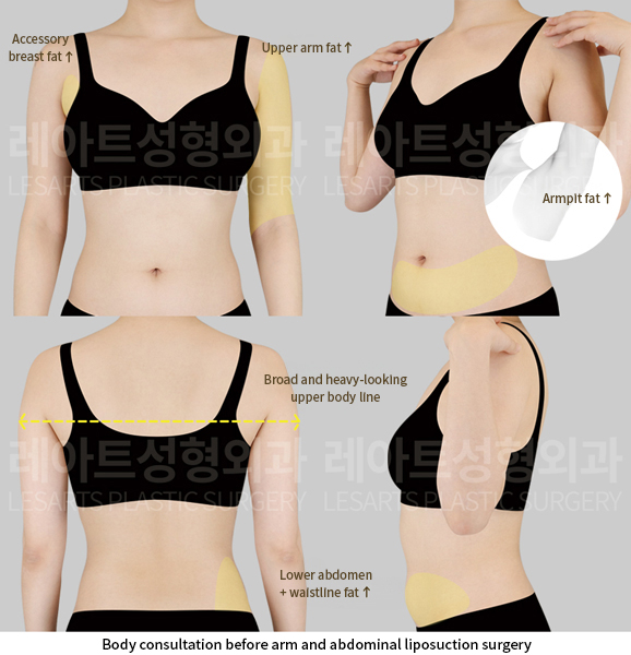 upper_body_liposuction_02_01_250624