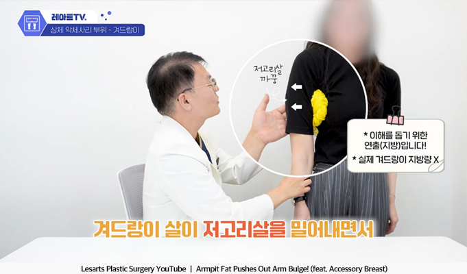 upper_body_liposuction_02_02_250513