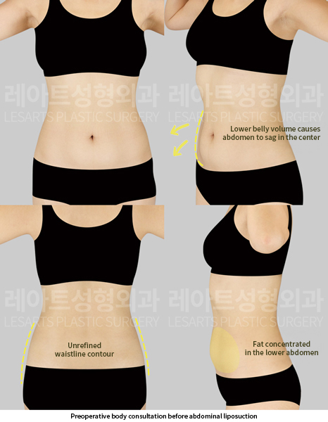 upper_body_liposuction_02_02_250528