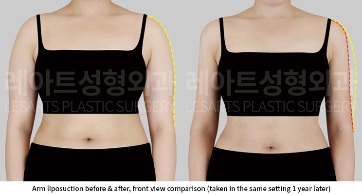 upper_body_liposuction_02_02_250613
